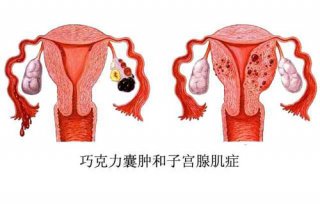 不可轻视的肿块——巧克力囊肿