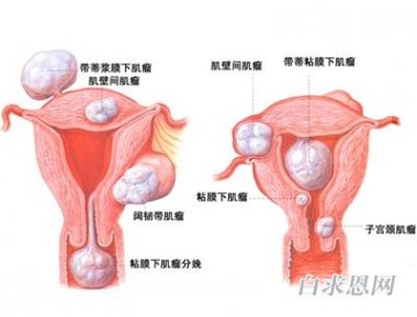 子宫肌瘤怎么治疗?